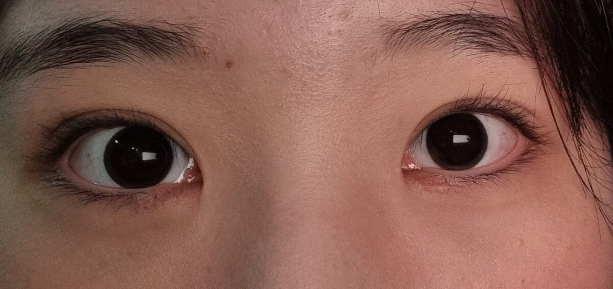 ตาสองชั้นของวัยรุ่น