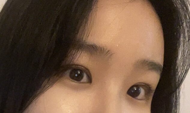 รีวิวการผ่าตัดทำตาสองชั้นของ ดร.คิม ฮงจิน