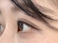 การยกกระชับเปลือกตาบนด้วยการยึดเกาะตามธรรมชาติ 1 มม. และการจัดตำแหน่งไขมันใต้เปลือกตาล่างใหม่