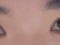 การผ่าตัดแก้ไขสายตาของ ดร.โด ออน-รก