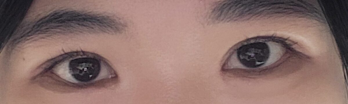 การผ่าตัดแก้ไขสายตาของ ดร.โด ออน-รก