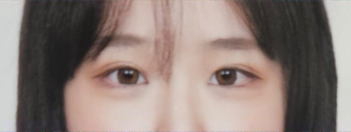การผ่าตัดทำตาสองชั้นครั้งแรก