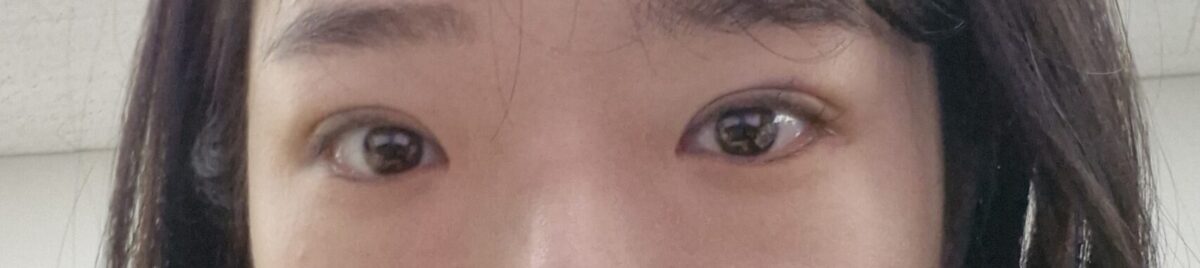 ผ่านมา 3 เดือนแล้วนับตั้งแต่ฉันเข้ารับการผ่าตัดตกแต่งหัวตาและผ่าตัดสร้างชั้นตาซ้อนโดยศัลยแพทย์คิม ฮงจิน