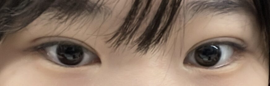 ฉันเข้ารับการผ่าตัดโดยผู้อำนวยการนา ยองซู ที่โรงพยาบาลอิลมิริ