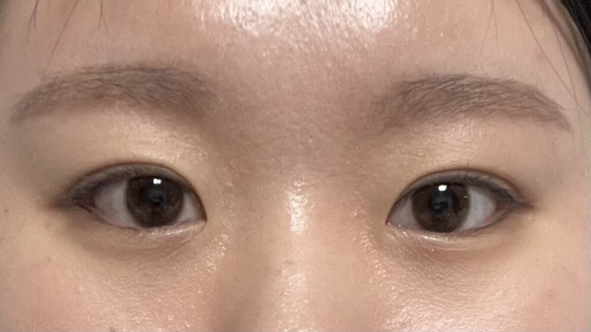 イルミリ自然癒着ペア
