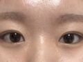 イルミリ自然癒着ペア