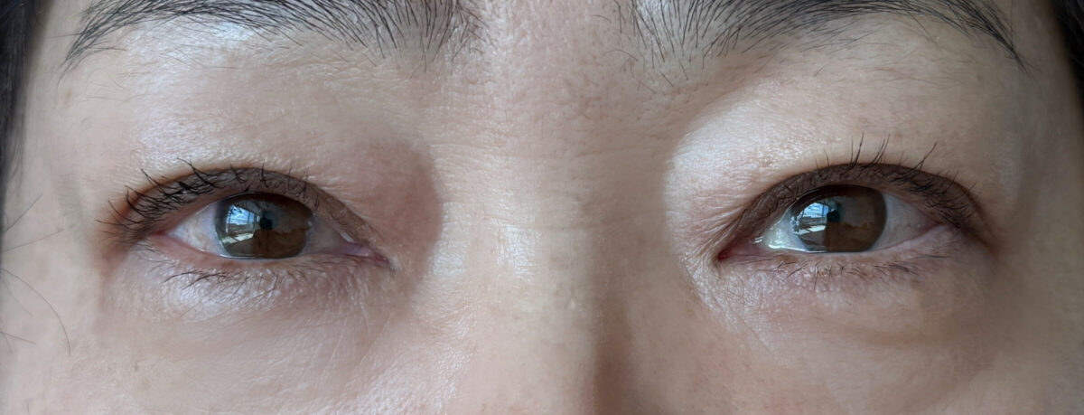 ผู้อำนวยการคิม ฮงจิน แห่ง Ilmiri + Double Eyelid Surgery