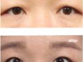 Nâng chân mày theo phương pháp của bác sĩ Kim Hong-jin