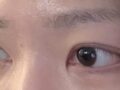 รีวิวหลังการผ่าตัดยกกระชับเปลือกตาบนด้วยวิธี Natural Adhesion 3.5 เดือน โดยผู้อำนวยการ โด ออน-ร็อก ที่คลินิกอิลมิริ