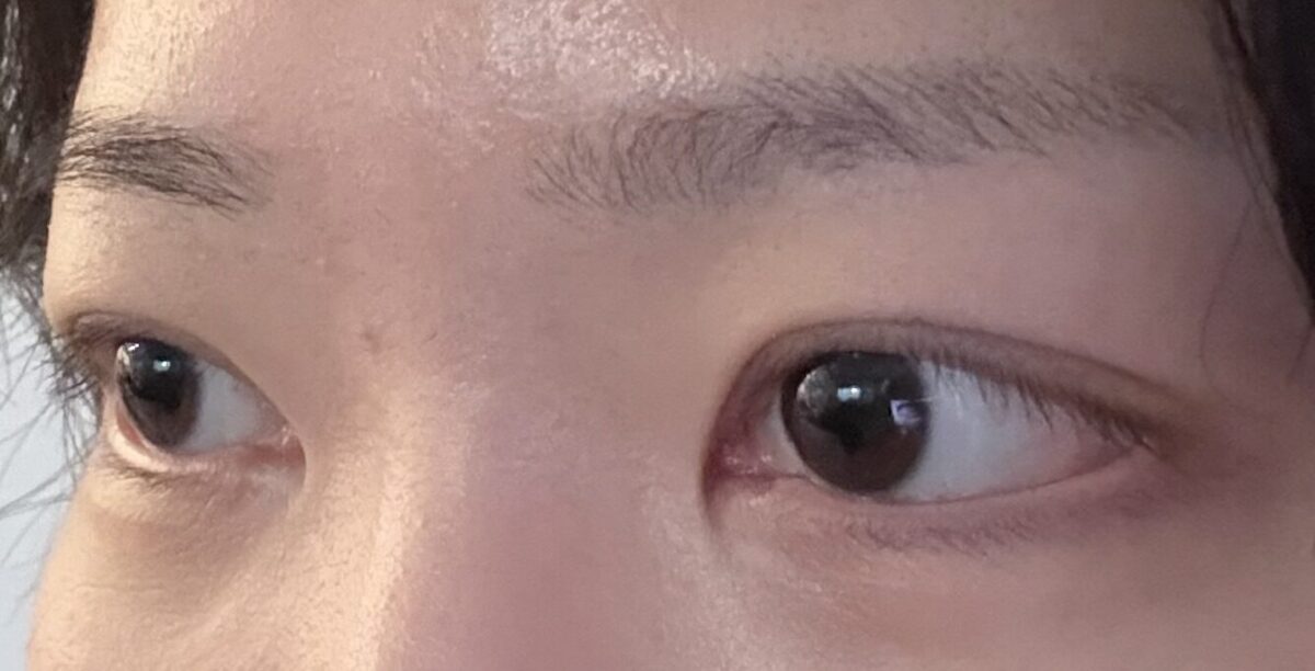 รีวิวหลังการผ่าตัดยกกระชับเปลือกตาบนด้วยวิธี Natural Adhesion 3.5 เดือน โดยผู้อำนวยการ โด ออน-ร็อก ที่คลินิกอิลมิริ
