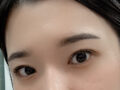 รีวิวการผ่าตัดแก้ไขหนังตาสองชั้น + ยกหนังตาบน โดยคุณหมอโด ออน-ร็อก ที่คลินิกอิลมิริ