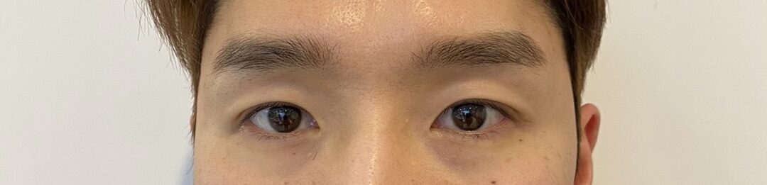 รีวิวการผ่าตัดแบบไม่ต้องกรีดแผลของ ดร.โด ออน-ร็อก!