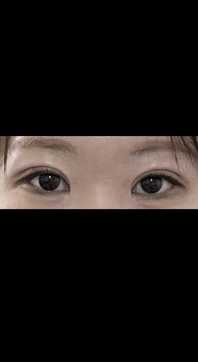 ศัลยกรรมตกแต่งดวงตา Ilmiri