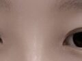 1 มม. + ไม่ต้องผ่าตัด