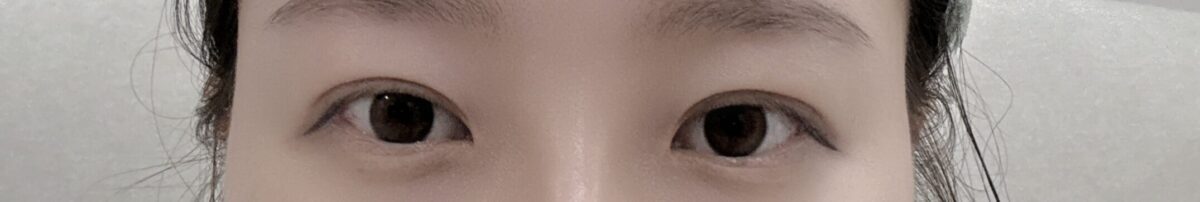 1 มม. + ไม่ต้องผ่าตัด