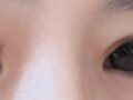 รีวิวการแก้ไขเปลือกตาโดย ดร.โด ออน-ร็อก