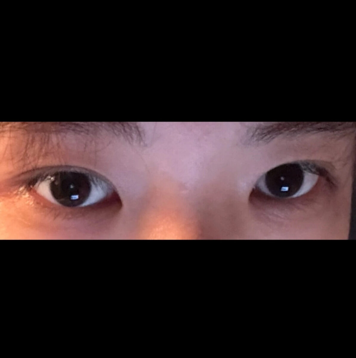 รีวิวการยกกระชับเปลือกตาบนด้วยวิธี Natural Adhesion ของคุณหมอคิม ฮงจิน