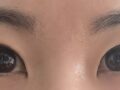 การผ่าตัดสร้างชั้นตาสองชั้นและเปลือกตาล่างโดยไม่ต้องกรีด 6 เดือน