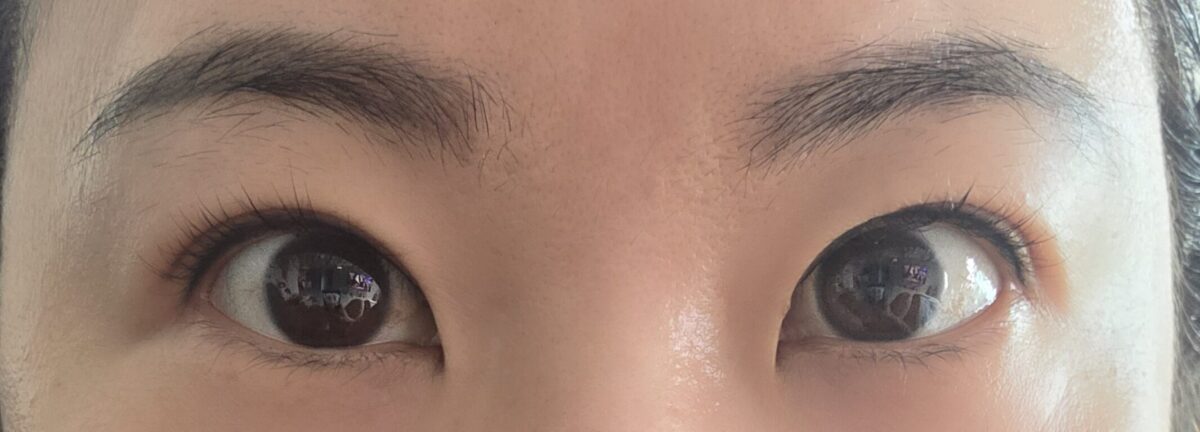 การผ่าตัดสร้างชั้นตาสองชั้นและเปลือกตาล่างโดยไม่ต้องกรีด 6 เดือน