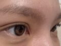 รีวิวการผ่าตัดเปลือกตาบนและรอยกรีดของ ดร. โด ออน-ร็อก