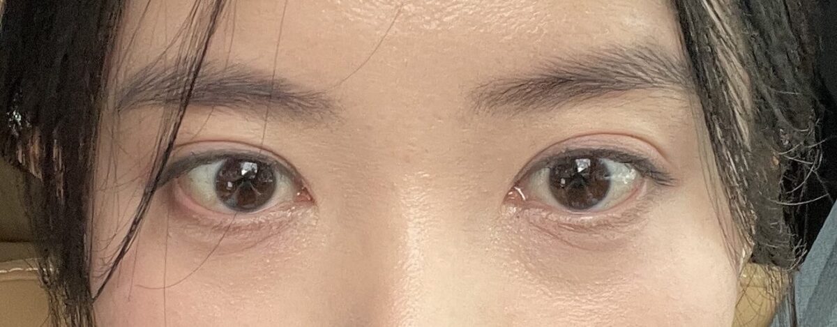 รีวิวการผ่าตัดแก้ไขความไม่สม่ำเสมอของดวงตา 1 มม.