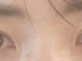 รีวิวการผ่าตัดแก้ไขแผลของ ดร.โด ออน-รก