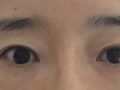 Review sau phẫu thuật