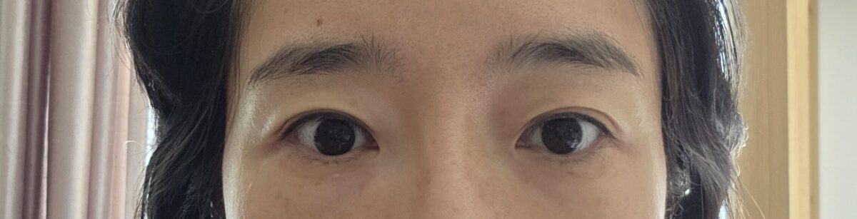 ศัลยกรรมตกแต่งใบหน้า Illimi (การปลูกถ่ายไขมันเปลือกตาบน)