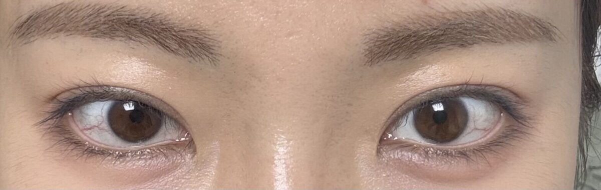 3 เดือนหลังการปลูกถ่ายไขมันเปลือกตาบนและการผ่าตัดทำตาสองชั้นแบบไม่กรีดแผล โดยผู้อำนวยการโด ออน-ร็อก ที่คลินิกอิลมิริ