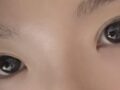 一毫米自然粘连  术后反馈