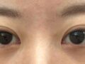 道言録院長二重まぶた再手術（埋没）+ウィットイム+デュートイム+ヘントイムのレビュー