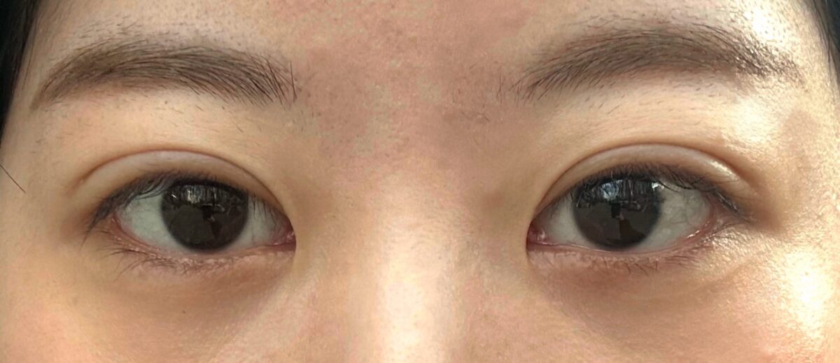 รีวิวการผ่าตัดแก้ไขเปลือกตาสองชั้น (เย็บซ่อนไหม) + ยกเปลือกตาบน + ศัลยกรรมตกแต่งมุมตาด้านข้าง + ยกเปลือกตาล่าง โดย ดร.โด ออน-ร็อก