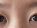 一毫米都彦禄院长  自然粘连+上眼角