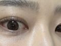 一毫米 全切双眼皮+上眼角+眼底脂肪重排 