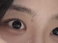 一毫米 都彦禄院长 双眼皮+前眼角+上眼角
