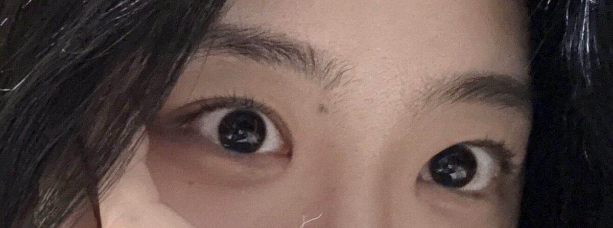 ศัลยกรรมตกแต่งเปลือกตาคู่ + ศัลยกรรมตกแต่งหัวตา + ศัลยกรรมเปลือกตาบน โดย ดร. โด ออน-ร็อก อิลมิริ