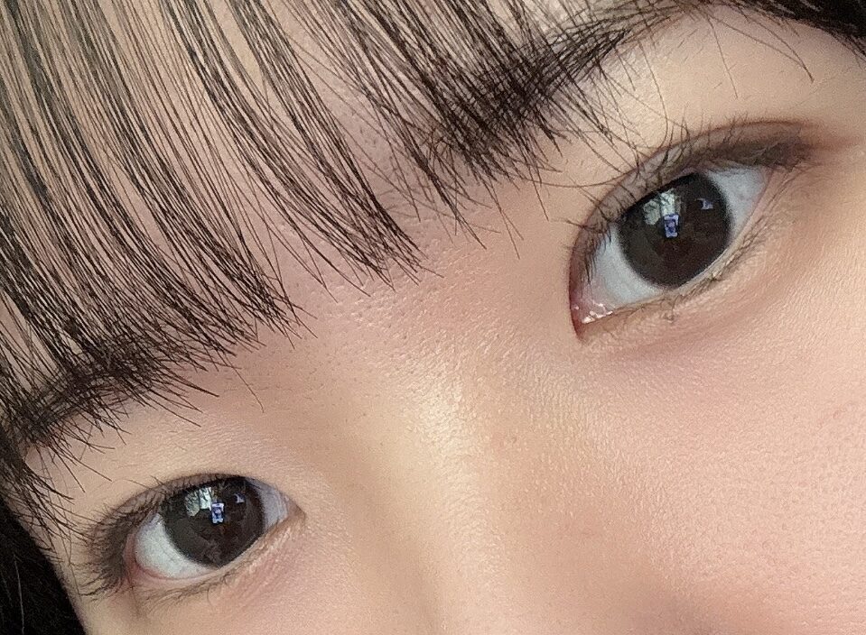 ดร. ฮงจิน คิม จากคลินิกศัลยกรรมตกแต่งอิลมิริ การยึดเกาะตามธรรมชาติ