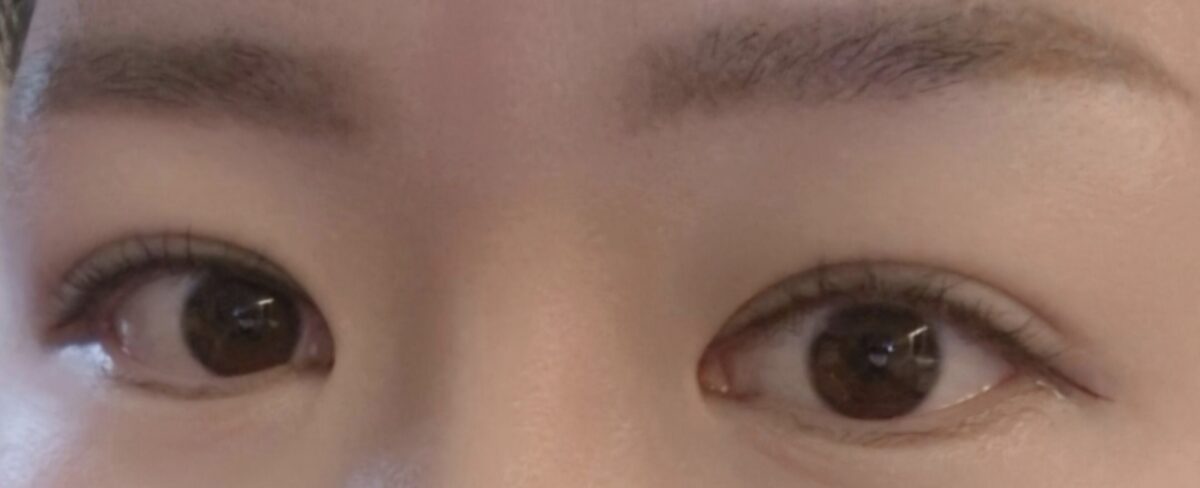 การผ่าตัดแก้ไขเปลือกตาด้วยแผลขนาด 1 มม. (ผู้กำกับ คิม ฮงจิน)