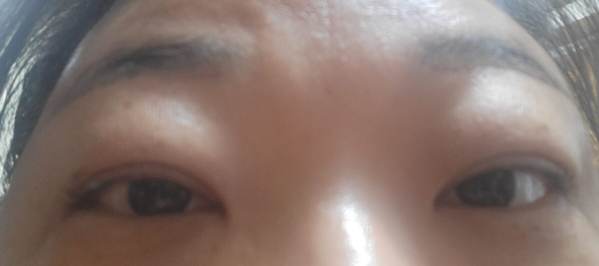 ศัลยกรรมตกแต่งเปลือกตาและยกคิ้ว