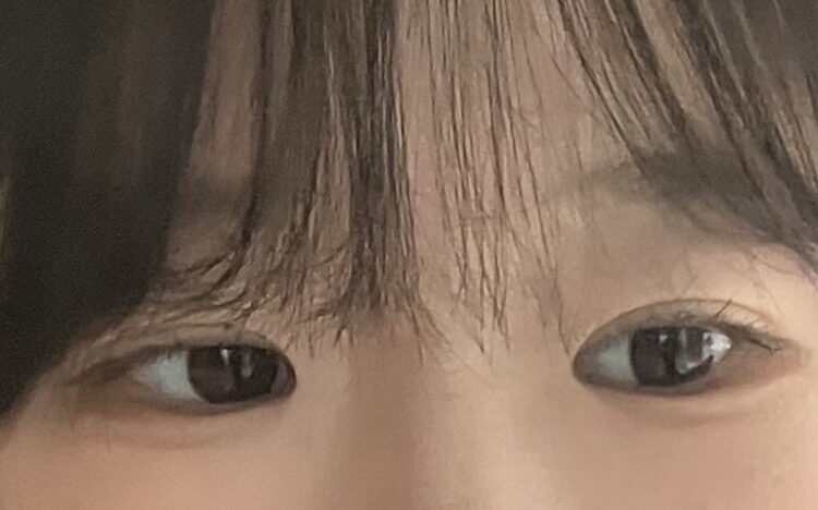 เทคนิคการผ่าตัดตกแต่งหัวตาแบบไม่ต้องกรีดของ ผู้กำกับ โด ออน-ร็อก