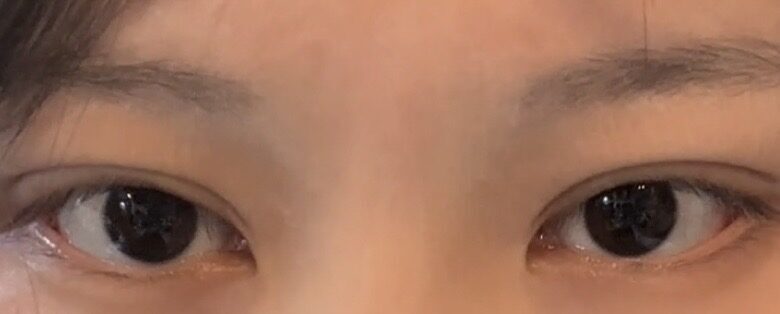 1 มม. (การยึดเกาะตามธรรมชาติ + การยกเปลือกตาบน)