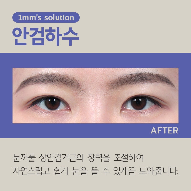 What is Ptosis Correction for Droopy Eyes? 사진 8