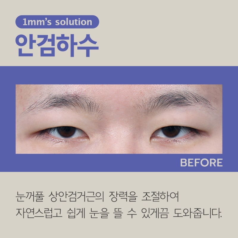 What is Ptosis Correction for Droopy Eyes? 사진 7
