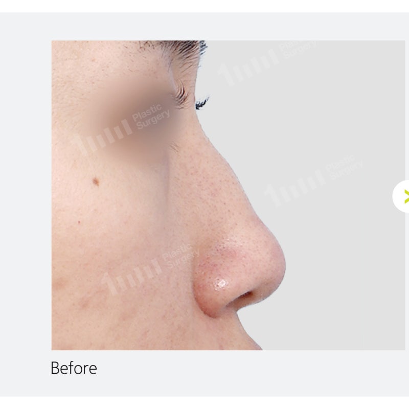 Alar Reduction? Nose Surgery by Type, Including Wide Nostril Correction 사진 5