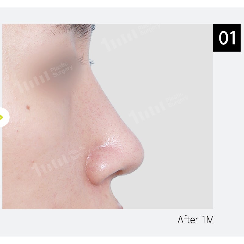 Alar Reduction? Nose Surgery by Type, Including Wide Nostril Correction 사진 6