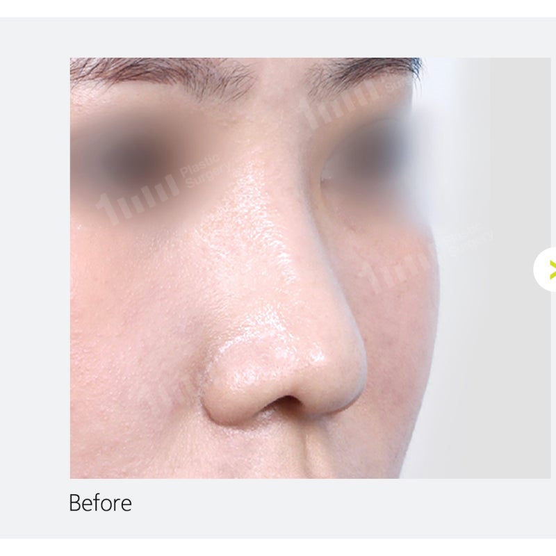 Alar Reduction? Nose Surgery by Type, Including Wide Nostril Correction 사진 8