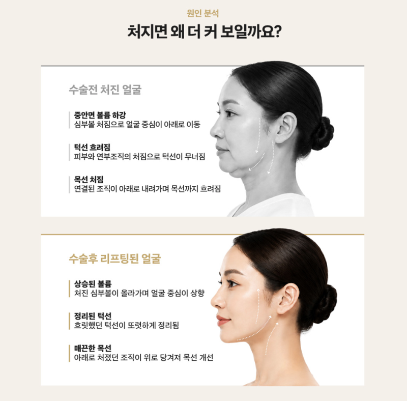 1mm Plastic Surgery Facefit Mini-Lift 사진 2