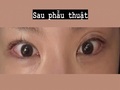 Phẫu thuật chỉnh sửa mí mắt đôi, định hình lại hình dáng mắt của đạo diễn Do Eon-rok.