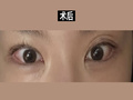 都彦禄院长 双眼皮修复，提肌修复