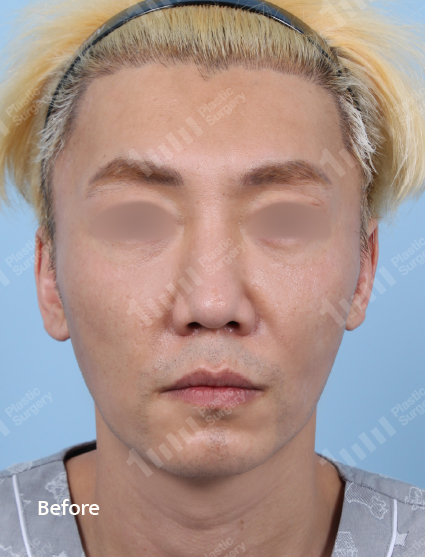 Before